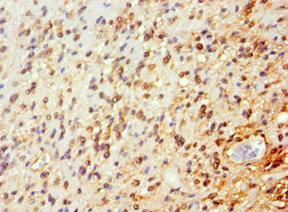 Immunohistochemistry of paraffin-embedded human glioma using CSB-PA864024ESR1HU at dilution of 1:100