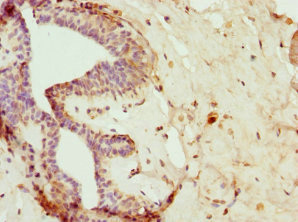 Immunohistochemistry of paraffin-embedded human breast cancer using CSB-PA866298DSR1HU at dilution of 1:100