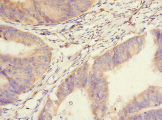 Immunohistochemistry of paraffin-embedded human endometrial cancer using CSB-PA875672ESR2HU at dilution of 1:100