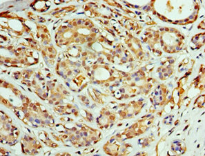 Immunohistochemistry of paraffin-embedded human breast cancer using CSB-PA880098ESR2HU at dilution of 1:100