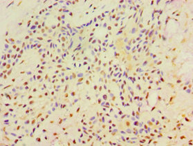 Immunohistochemistry of paraffin-embedded human breast cancer using CSB-PA880129ESR1HU at dilution of 1:100