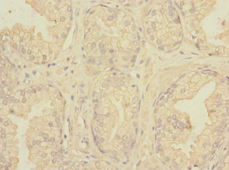 Immunohistochemistry of paraffin-embedded human prostate cancer using CSB-PA882076ESR2HU at dilution of 1:100