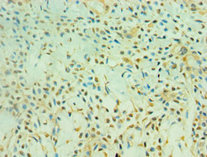 Immunohistochemistry of paraffin-embedded human breast cancer using CSB-PA882102ESR1HU at dilution of 1:100