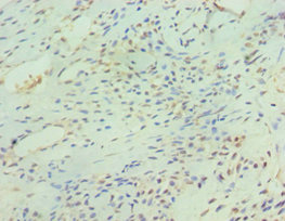 Immunohistochemistry of paraffin-embedded human breast cancer using CSB-PA882102ESR2HU at dilution of 1:100