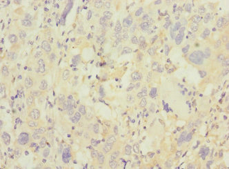 Immunohistochemistry of paraffin-embedded human liver cancer using CSB-PA890740ESR1HU at dilution of 1:100
