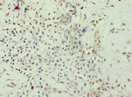 Immunohistochemistry of paraffin-embedded human breast cancer using CSB-PA892479ESR1HU at dilution of 1:100