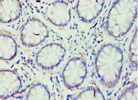 Immunohistochemistry of paraffin-embedded human colon cancer using CSB-PA892479ESR1HU at dilution of 1:100
