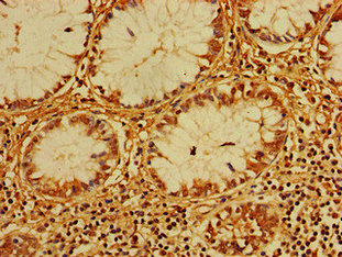 Immunohistochemistry of paraffin-embedded human colon cancer using CSB-PA005256LA01HU at dilution of 1:100