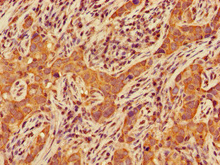 Immunohistochemistry of paraffin-embedded human pancreatic cancer using CSB-PA005256LA01HU at dilution of 1:100