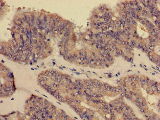 Immunohistochemistry of paraffin-embedded human endometrial cancer using CSB-PA005932EA01HU at dilution of 1:100 Immunohistochemistry of paraffin-embedded human endometrial cancer using CSB-PA005932EA01HU at dilution of 1:100
