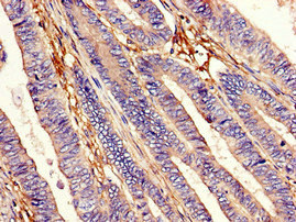 Immunohistochemistry of paraffin-embedded human colon cancer using CSB-PA007405LA01HU at dilution of 1:100