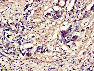 Immunohistochemistry of paraffin-embedded human gastric cancer using CSB-PA007553LA01HU at dilution of 1:100 Immunohistochemistry of paraffin-embedded human gastric cancer using CSB-PA007553LA01HU at dilution of 1:100