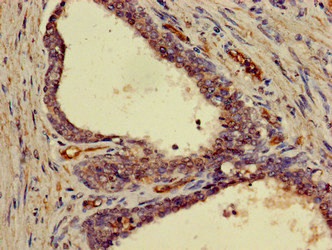 Immunohistochemistry of paraffin-embedded human prostate cancer using CSB-PA009004LA01HU at dilution of 1:100