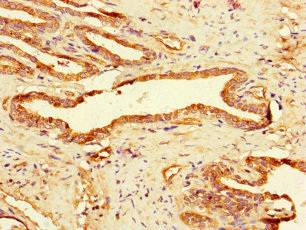 Immunohistochemistry of paraffin-embedded human prostate cancer using CSB-PA009125LA01HU at dilution of 1:100