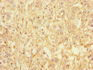 Immunohistochemistry of paraffin-embedded human pancreatic cancer using CSB-PA009125LA01HU at dilution of 1:100