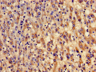Immunohistochemistry of paraffin-embedded human liver cancer using CSB-PA009322LA01HU at dilution of 1:100