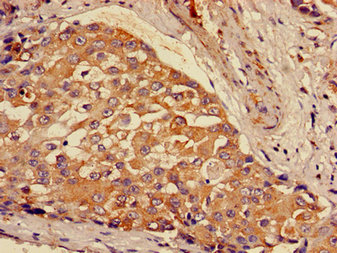 Immunohistochemistry of paraffin-embedded human breast cancer using CSB-PA009322LA01HU at dilution of 1:100