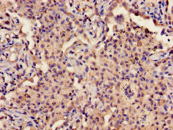 Immunohistochemistry of paraffin-embedded human lung cancer using CSB-PA009690LA01HU at dilution of 1:100 Immunohistochemistry of paraffin-embedded human lung cancer using CSB-PA009690LA01HU at dilution of 1:100