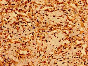Immunohistochemistry of paraffin-embedded human lung cancer using CSB-PA009995LA01HU at dilution of 1:100