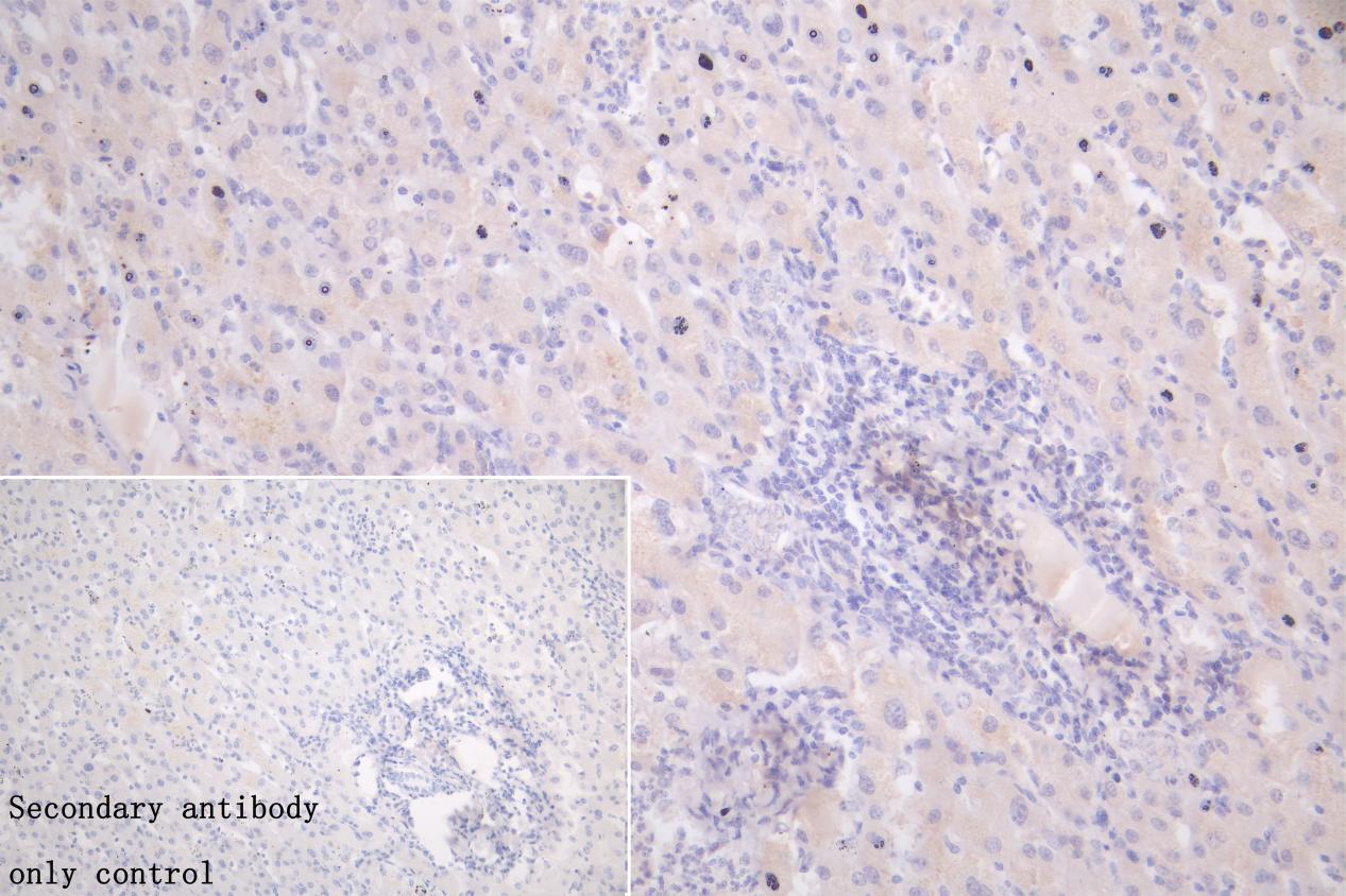 IHC image of CSB-PA011018LA01HU diluted at 1:50 and staining in paraffin-embedded human liver cancer performed on a Leica BondTM system. After dewaxing and hydration, antigen retrieval was mediated by high pressure in a citrate buffer (pH 6.0). Section was blocked with 10% normal goat serum 30min at RT. Then primary antibody (1% BSA) was incubated at 4°C overnight. The primary is detected by a Goat anti-rabbit polymer IgG labeled by HRP and visualized using 0.05% DAB. Secondary antibody only control: uses 1% BSA instead of primary antibody.