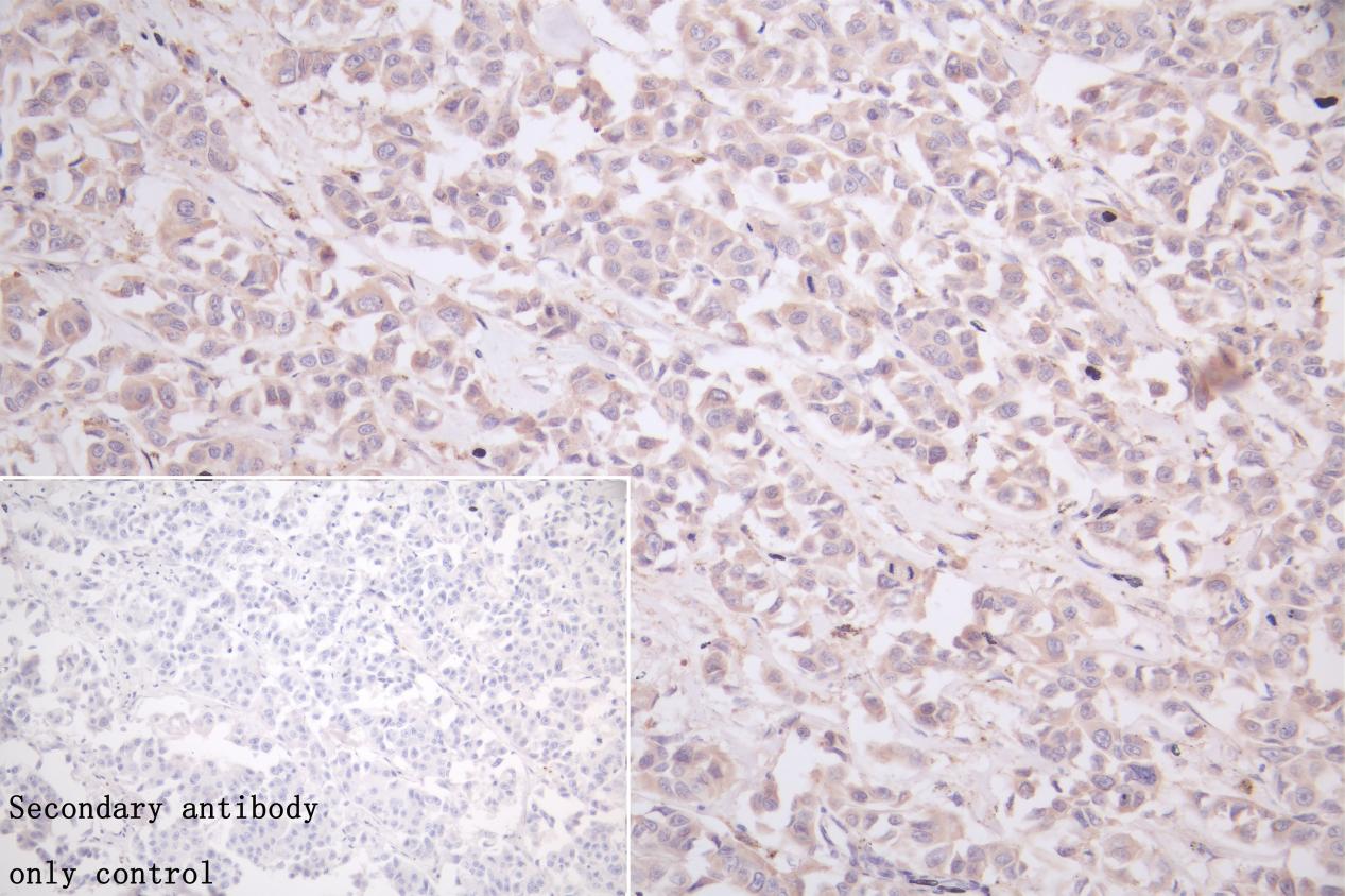 IHC image of CSB-PA011018LA01HU diluted at 1:50 and staining in paraffin-embedded human breast cancer performed on a Leica BondTM system. After dewaxing and hydration, antigen retrieval was mediated by high pressure in a citrate buffer (pH 6.0). Section was blocked with 10% normal goat serum 30min at RT. Then primary antibody (1% BSA) was incubated at 4°C overnight. The primary is detected by a Goat anti-rabbit polymer IgG labeled by HRP and visualized using 0.05% DAB.Secondary antibody only control: uses 1% BSA instead of primary antibody.