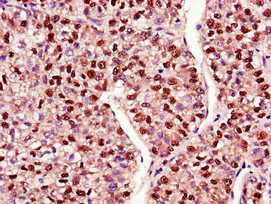 Immunohistochemistry of paraffin-embedded human liver cancer using CSB-PA013413LA01HU at dilution of 1:100