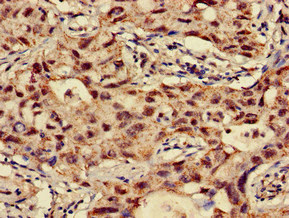Immunohistochemistry of paraffin-embedded human lung cancer using CSB-PA015464LA01HU at dilution of 1:100 Immunohistochemistry of paraffin-embedded human lung cancer using CSB-PA015464LA01HU at dilution of 1:100