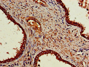 Immunohistochemistry of paraffin-embedded human prostate cancer using CSB-PA016066LA01HU at dilution of 1:100