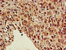 Immunohistochemistry of paraffin-embedded human glioma using CSB-PA016066LA01HU at dilution of 1:100