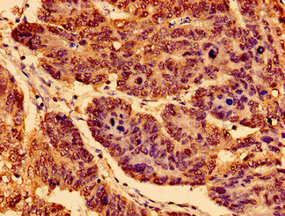 Immunohistochemistry of paraffin-embedded human gastric cancer using CSB-PA016133LA01HU at dilution of 1:100