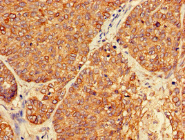 Immunohistochemistry of paraffin-embedded human ovarian cancer using CSB-PA017788LA01HU at dilution of 1:100