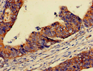 Immunohistochemistry of paraffin-embedded human colon cancer using CSB-PA017788LA01HU at dilution of 1:100