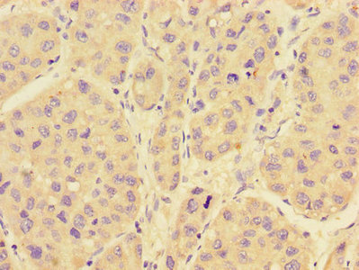 Immunohistochemistry of paraffin-embedded human liver cancer using CSB-PA019179LA01HU at dilution of 1:100