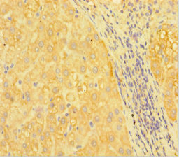 Immunohistochemistry of paraffin-embedded human liver tissue using CSB-PA019308HA01HU at dilution of 1:100 Immunohistochemistry of paraffin-embedded human liver tissue using CSB-PA019308HA01HU at dilution of 1:100