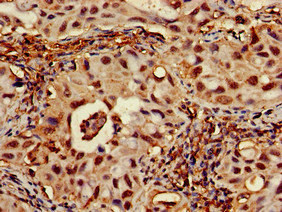 Immunohistochemistry of paraffin-embedded human lung cancer using CSB-PA020088LA01HU at dilution of 1:100 Immunohistochemistry of paraffin-embedded human lung cancer using CSB-PA020088LA01HU at dilution of 1:100