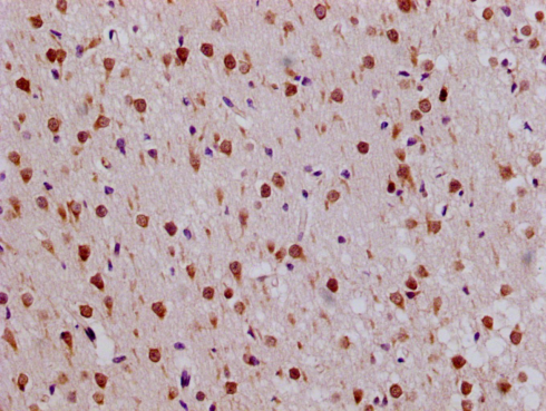 Immunohistochemistry of paraffin-embedded human endometrial cancer using CSB-PA020160LA01HU at dilution of 1:100