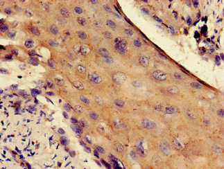 Immunohistochemistry of paraffin-embedded human cervical cancer using CSB-PA020457LA01HU at dilution of 1:100 Immunohistochemistry of paraffin-embedded human cervical cancer using CSB-PA020457LA01HU at dilution of 1:100