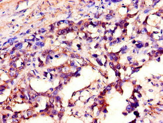 Immunohistochemistry of paraffin-embedded human gastric cancer using CSB-PA021209LA01HU at dilution of 1:100 Immunohistochemistry of paraffin-embedded human gastric cancer using CSB-PA021209LA01HU at dilution of 1:100