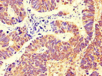 Immunohistochemistry of paraffin-embedded human ovarian cancer using CSB-PA021226LA01HU at dilution of 1:100