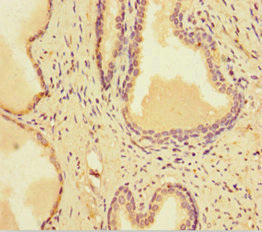 Immunohistochemistry of paraffin-embedded human prostate cancer using CSB-PA021798LA01HU at dilution of 1:100 Immunohistochemistry of paraffin-embedded human prostate cancer using CSB-PA021798LA01HU at dilution of 1:100