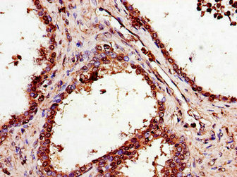 Immunohistochemistry of paraffin-embedded human prostate cancer using CSB-PA021854LA01HU at dilution of 1:100 Immunohistochemistry of paraffin-embedded human prostate cancer using CSB-PA021854LA01HU at dilution of 1:100