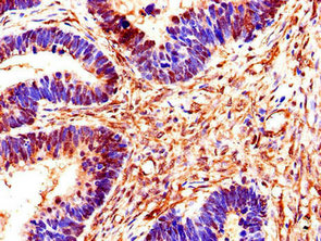 Immunohistochemistry of paraffin-embedded human ovarian cancer using CSB-PA021854LA01HU at dilution of 1:100