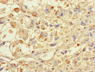 Immunohistochemistry of paraffin-embedded human melanoma using CSB-PA022470LA01HU at dilution of 1:100 Immunohistochemistry of paraffin-embedded human melanoma using CSB-PA022470LA01HU at dilution of 1:100