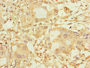 Immunohistochemistry of paraffin-embedded human pancreatic cancer using CSB-PA022470LA01HU at dilution of 1:100