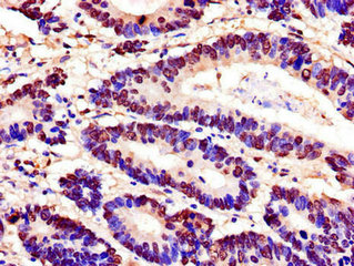 Immunohistochemistry of paraffin-embedded human colon cancer using CSB-PA022518LA01HU at dilution of 1:100