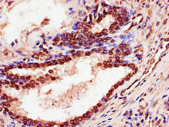 Immunohistochemistry of paraffin-embedded human prostate cancer using CSB-PA022518LA01HU at dilution of 1:100