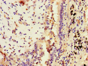 Immunohistochemistry of paraffin-embedded human lung cancer using CSB-PA022811LA01HU at dilution of 1:100 Immunohistochemistry of paraffin-embedded human lung cancer using CSB-PA022811LA01HU at dilution of 1:100