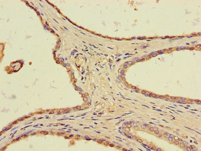 Immunohistochemistry of paraffin-embedded human prostate cancer using CSB-PA023595LA01HU at dilution of 1:100 Immunohistochemistry of paraffin-embedded human prostate cancer using CSB-PA023595LA01HU at dilution of 1:100