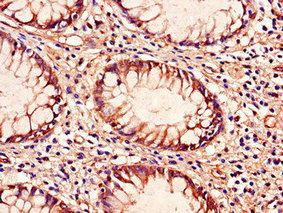 Immunohistochemistry of paraffin-embedded human colon cancer using CSB-PA023608LA01HU at dilution of 1:100 Immunohistochemistry of paraffin-embedded human colon cancer using CSB-PA023608LA01HU at dilution of 1:100