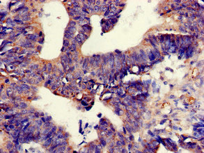 Immunohistochemistry of paraffin-embedded human colon cancer using CSB-PA023998LA01HU at dilution of 1:100